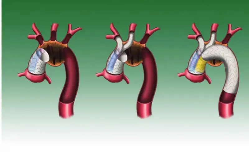 TAVR / cardiac valve device