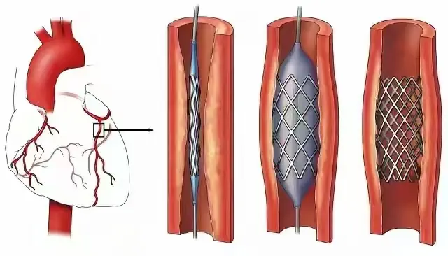 Vascular prosthesis (descriptive)