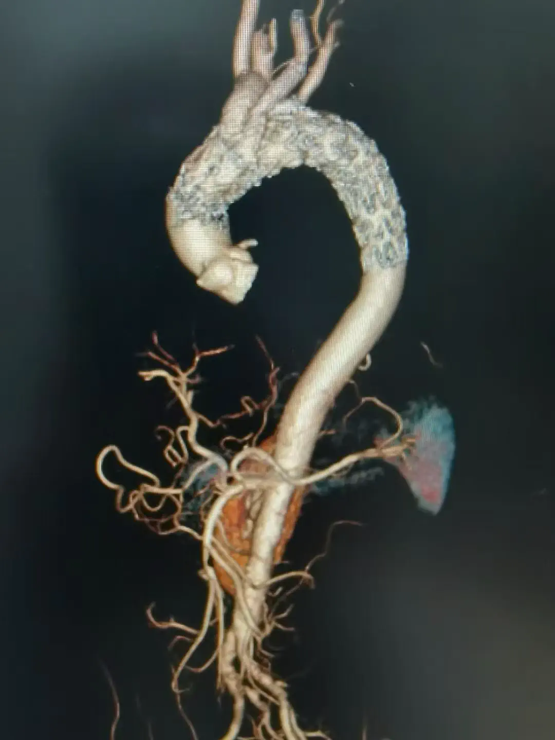 Left-ventricular assist device (artificial heart)